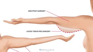 Mini Arm Lift 2025: A Quick Fix for Sagging Skin