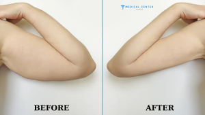 Mini Arm Lift 2025: A Quick Fix for Sagging Skin