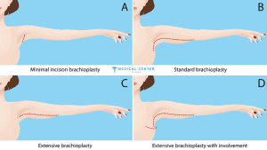 Mini Arm Lift 2025: A Quick Fix for Sagging Skin