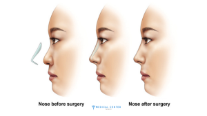 The Pros and Cons of Rhinoplasty Surgery Abroad