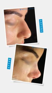 The Benefits of Non-Invasive Rhinoplasty in 2025