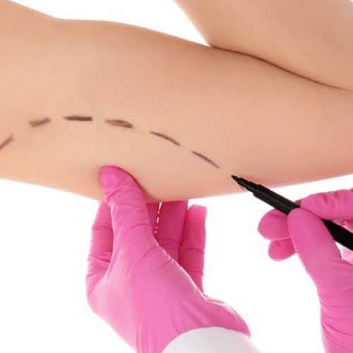 Mini Arm Lift 2025: A Quick Fix for Sagging Skin Mini Arm Lift 2025: A Quick Fix for Sagging Skin