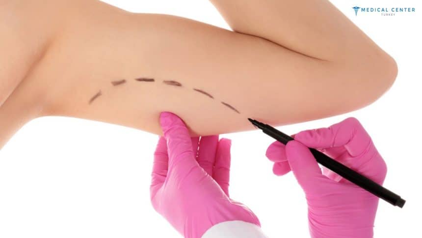 Mini Arm Lift 2025: A Quick Fix for Sagging Skin