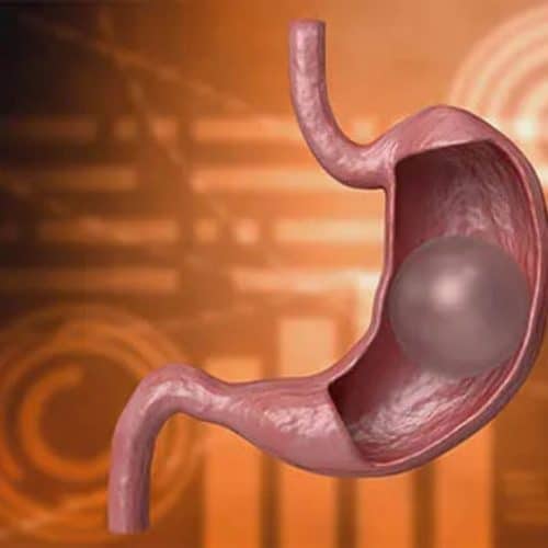 Gastric Balloon in Istanbul 2025: Time to Heal