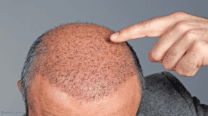 Understanding the Different Types of Hair Transplants and Which One Is Best