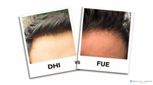 Understanding the Different Types of Hair Transplants and Which One Is Best