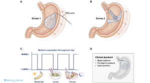 Gastric Balloon in Istanbul 2025: Time to Heal