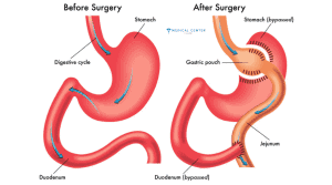 Are You Eligible for Gastric Bypass Surgery in Turkey?