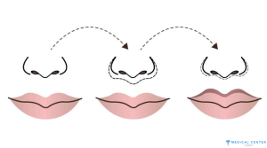 How Much is a Lip Lift in Turkey 2025 1