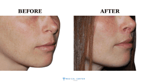 How Much is a Lip Lift in Turkey 2025 2