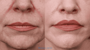 The Lip Fillers Cost in Turkey 2025