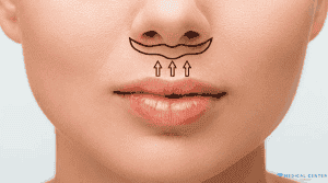 How Much is a Lip Lift in Turkey 2025 4