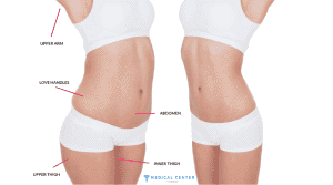 Is a Full Body Liposuction Worth It in Turkey?