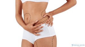 Is a Full Body Liposuction Worth It in Turkey?