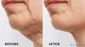 Neck Lift (Platysmaplasty) in Turkey 2025 