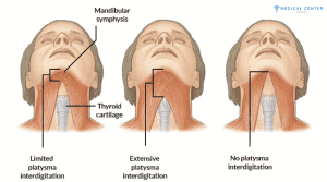 Neck Lift (Platysmaplasty) in Turkey 2025 