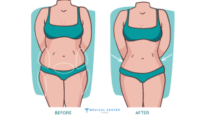 What Are the Risks Involved in Liposuction?