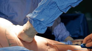 What Are the Risks Involved in Liposuction?