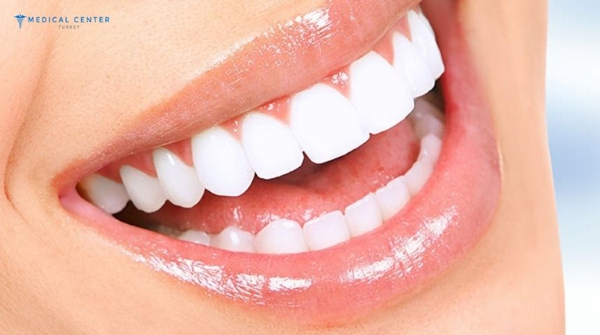 What You Need to Know About Dental Veneers in Turkey 2025 What You Need to Know About Dental Veneers in Turkey 2025