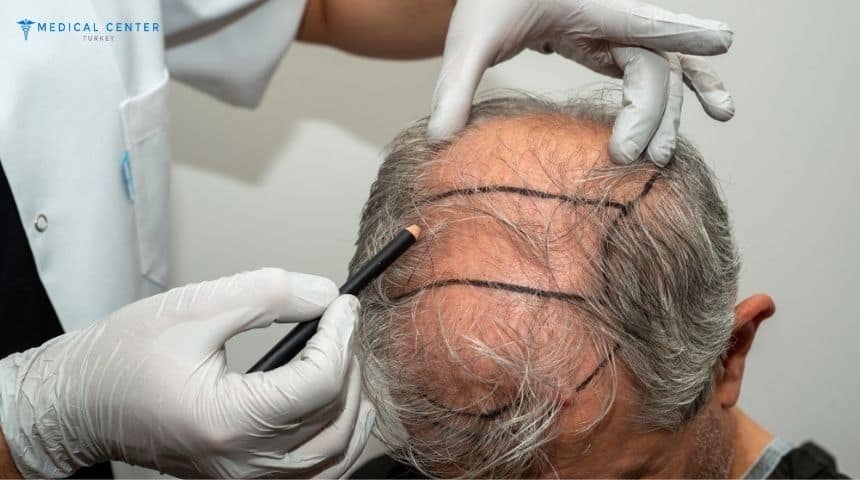 Understanding the Different Types of Hair Transplants and Which One Is Best? Understanding the Different Types of Hair Transplants and Which One Is Best?