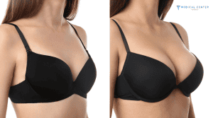 Why Breast Augmentations are Trending in 2026?