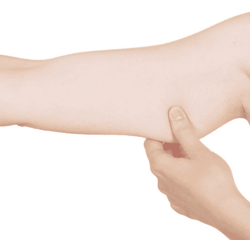 How to Recover After Arm Lift ? How to Recover After Arm Lift ?