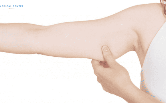 How to Recover After Arm Lift ?