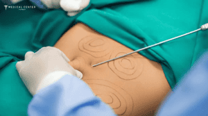 Why is Everyone Talking About Liposuction in Turkey?