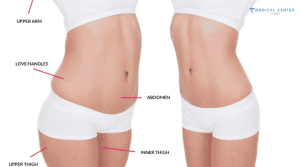 Why is Everyone Talking About Liposuction in Turkey?