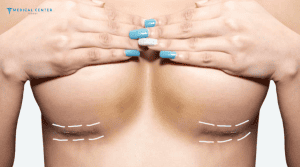 Why Breast Augmentations are Trending in 2026?