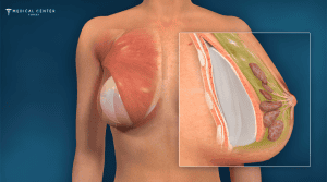 Why Breast Augmentations are Trending in 2026?