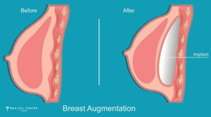 Why Breast Augmentations are Trending in 2026?