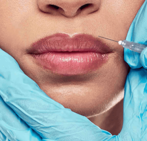 How Long Do Lip Filler Last?