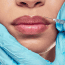 How Long Do Lip Filler Last?