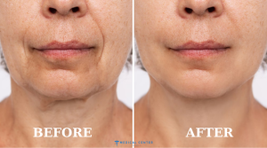 Can You Undergo a Facial Fat Transfer in Turkey?