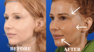 Can You Undergo a Facial Fat Transfer in Turkey?