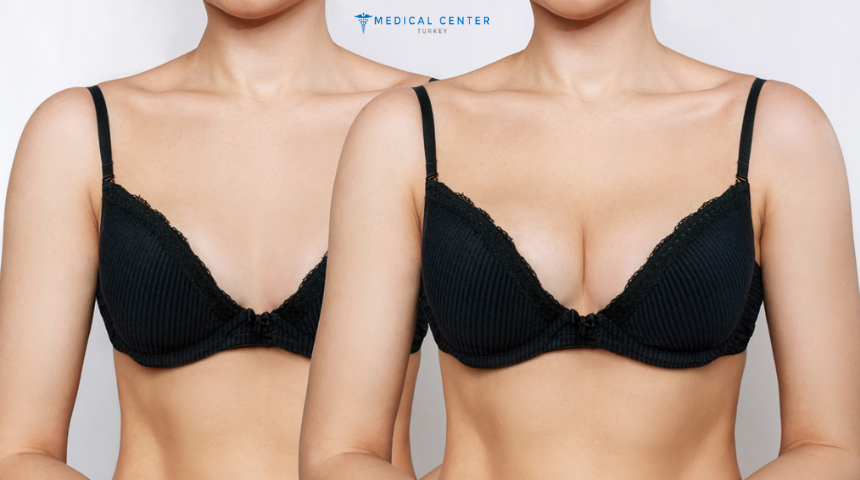 Breast Augmentation