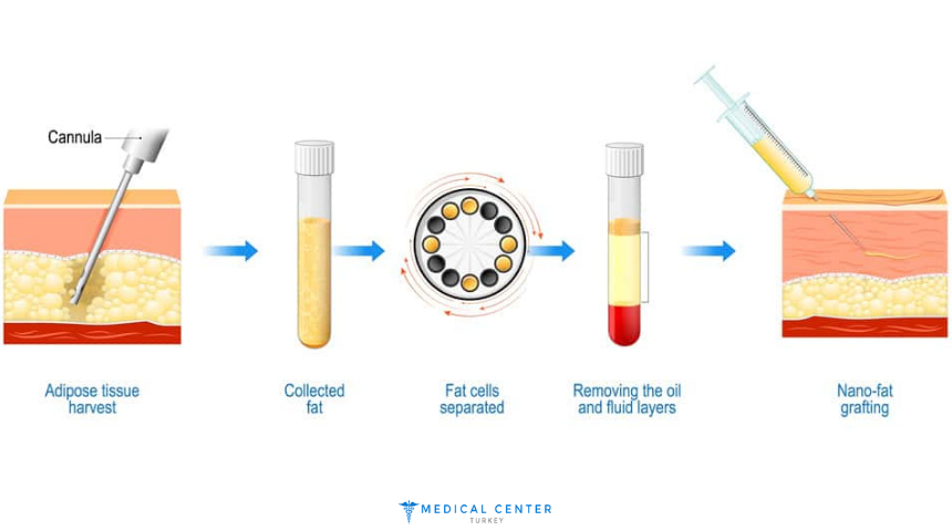 Fat Injection in 2025
