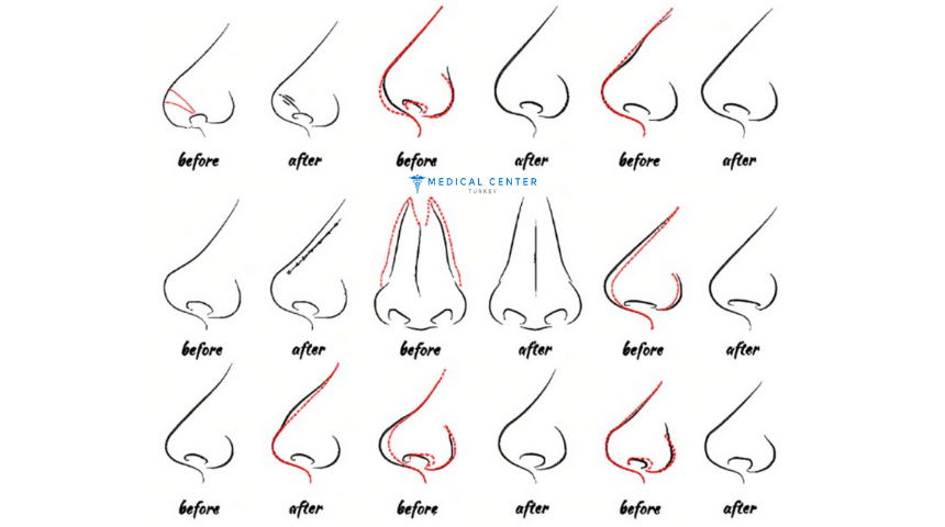 What Are the Differences Between Rhinoplasty Options in 2025?