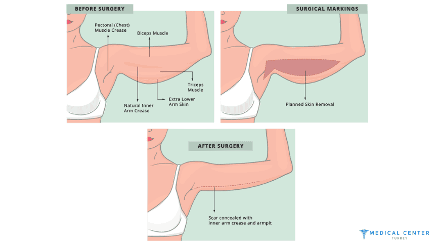 Why 2025 is the Best Time to Get a Mini Arm Lift?