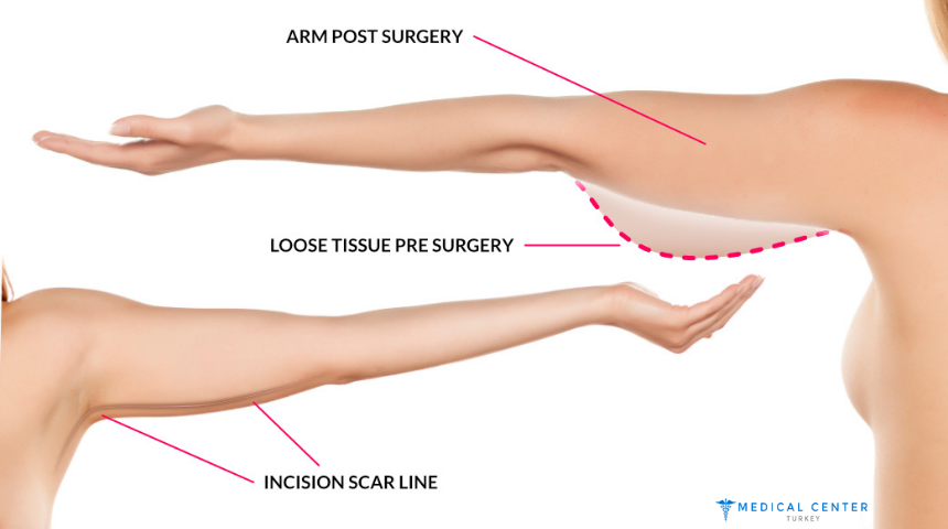 Why 2025 is the Best Time to Get a Mini Arm Lift?