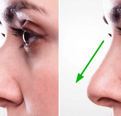 What Are the Differences Between Rhinoplasty Options in 2025? What Are the Differences Between Rhinoplasty Options in 2025?