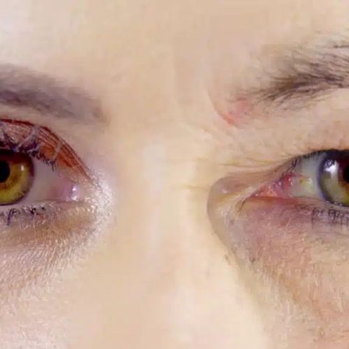 Say Goodbye to Droopy Eyelids with Eye Lift in Turkey Say Goodbye to Droopy Eyelids with Eye Lift in Turkey