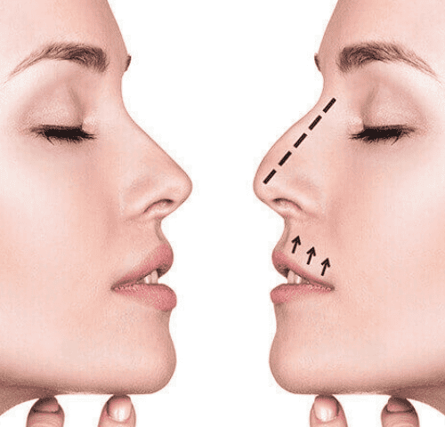 Why Is 2026 the Best Year to Get a Nose Job ?