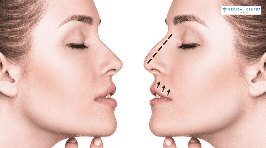 Why Is 2026 the Best Year to Get a Nose Job ?