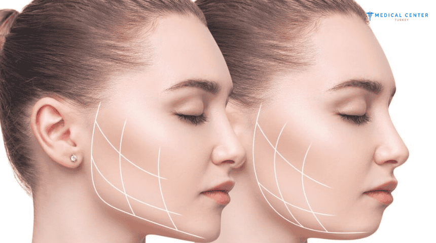 What to Expect From Jawline in Turkey
