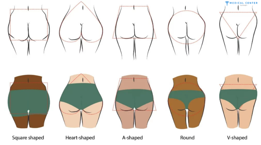 Butt Lift Surgery in Turkey 2025