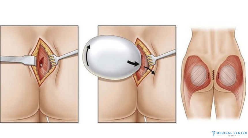 Butt Lift Surgery in Turkey 2025