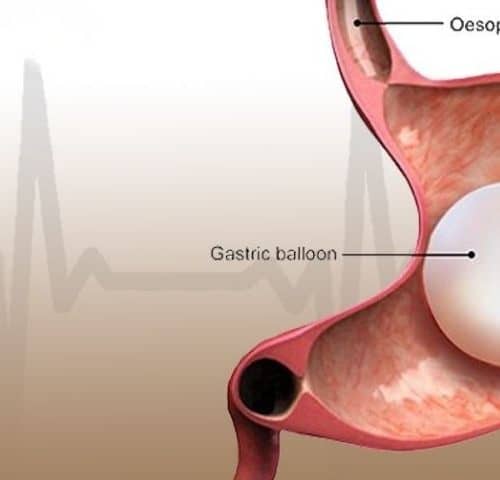 Gastric Balloon Surgery in 2025