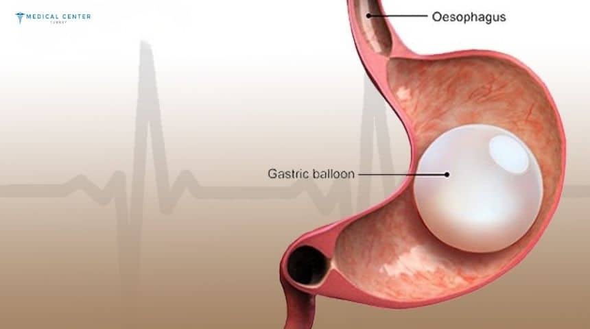 Gastric Balloon Surgery in 2025
